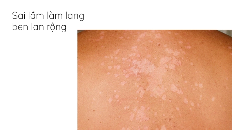 Thảo dược tự nhiên diệt nấm lang ben