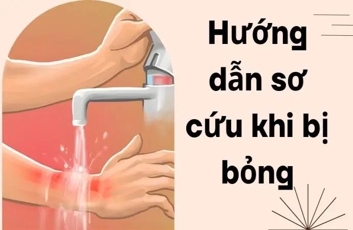Hướng dẫn sơ cứu khi bị bỏng đúng cách tránh để lại sẹo