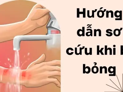 Hướng dẫn sơ cứu khi bị bỏng đúng cách tránh để lại sẹo