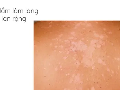 Tôi đã sạch lang ben nhờ áp dụng mẹo dân gian tại nhà này